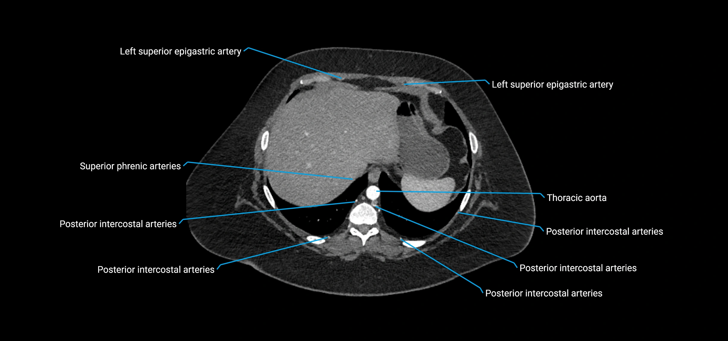 CTA abdomen axial cross sectional anatomy labelled image_23 (2).webp